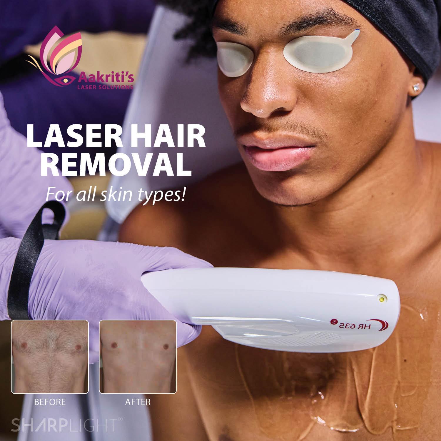 Facial Laser